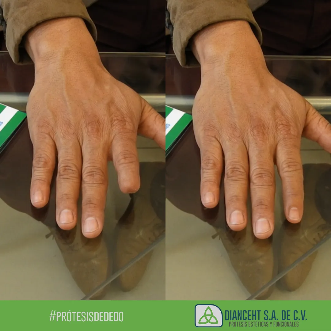 Finger prosthesis